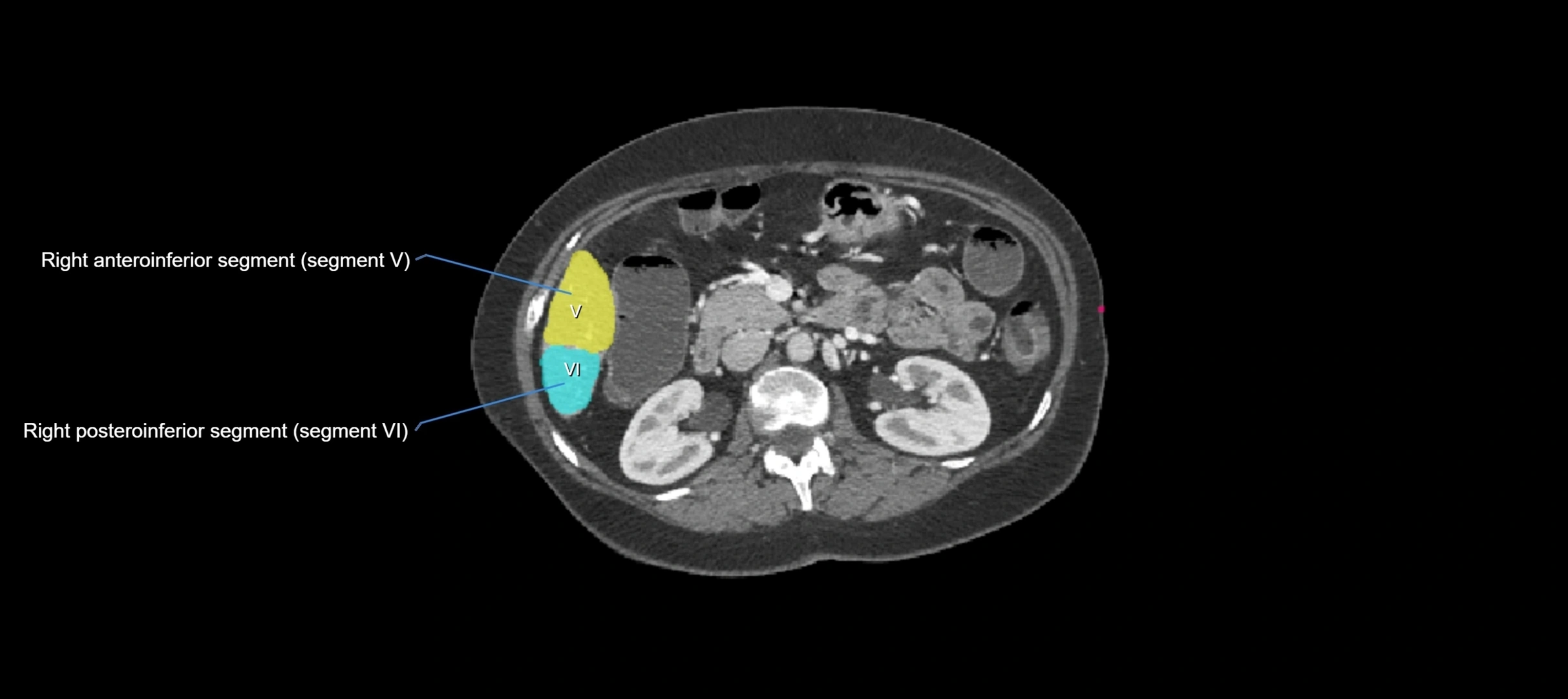 CT liver segments axial cross sectional anatomy labelled image-00020.webp